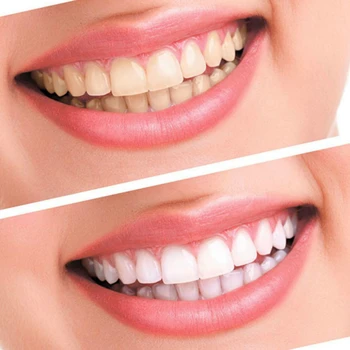 Nov Komplet za Beljenje Zob z led luči 44% Peroksid Zobni Beljenje Sistem Oralni Gel Kit Zob Whitener Zobozdravstvena Oprema