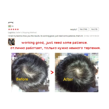 5PCS OMY LADY Anti Hair Loss Rast Las Spray Eterično Olje, Tekočine Za Moške, Ženske Suhe Lase Regeneracijo Popravila izpadanje Las